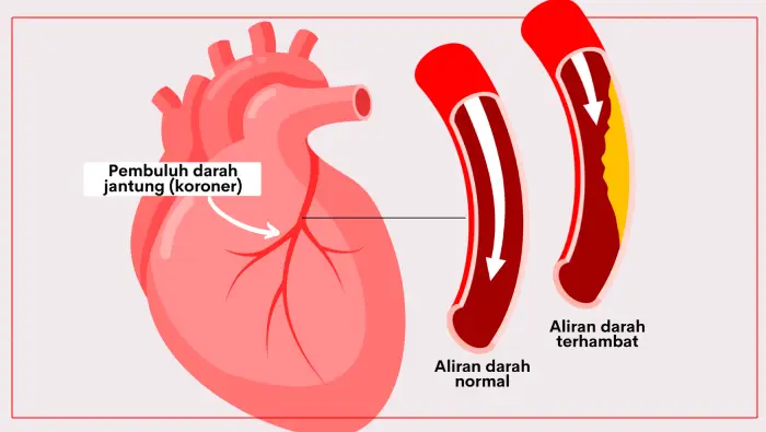 arteri koroner adalah