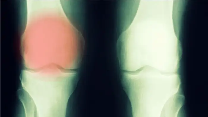 penyebab tumor tulang